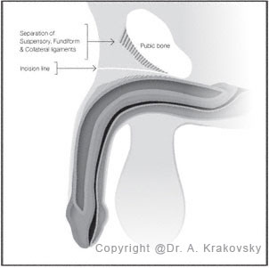 Penis Lengthening Surgery Part Two